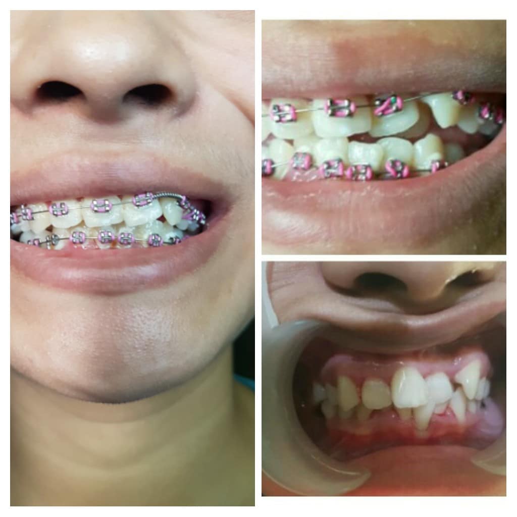  Behel  Gigi di Dalam Lingual  Braces Dokter Gigi